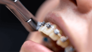 Braces Cost