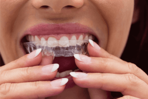 Retainer Replacement