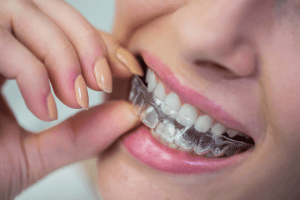 Retainer Replacement