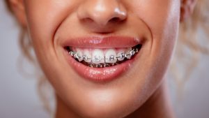 Braces