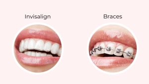 Invisalign Vs Braces
