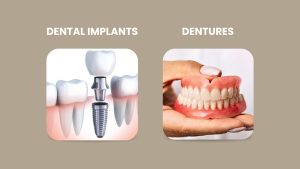Dental Implants Vs Dentures