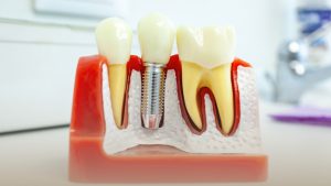 Dental Implants