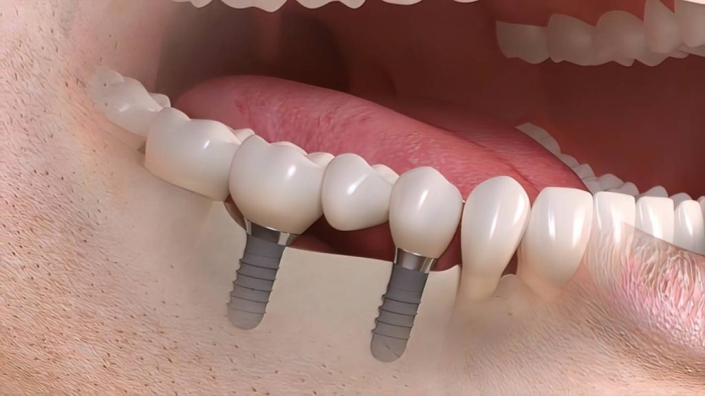 Dental Bridges