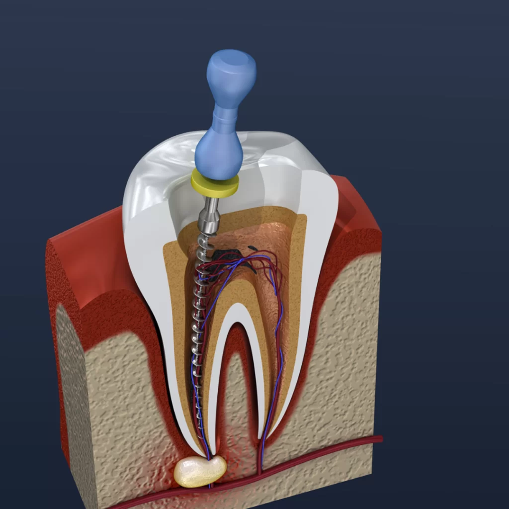 Root Canal